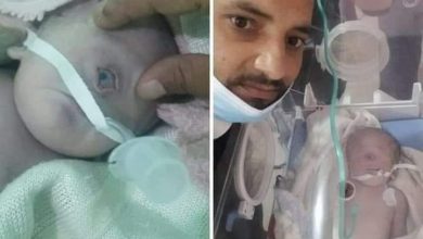 صورة بالفيديو.. شاهد ولادة طفل بعين واحدة فى اليمن
